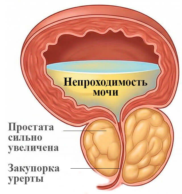 Третья стадия аденомы простаты, необратимые изменения мочевых путей и почек