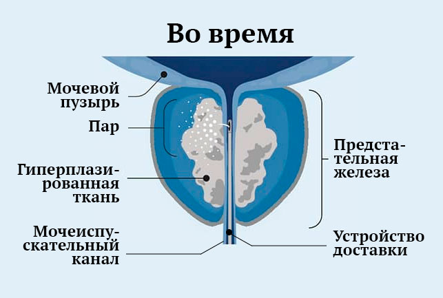 Воздействие водяного пара Rezūm на ткань простаты